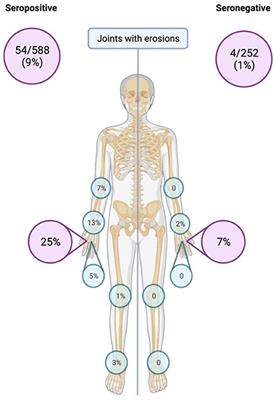 Patients with seronegative rheumatoid arthritis have a different phenotype than seropositive patients: A clinical and <mark class="highlighted">ultrasound study</mark>